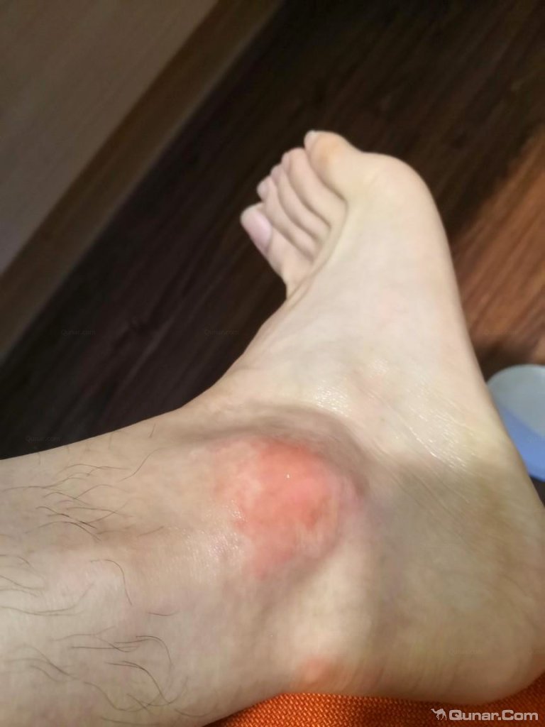 应该是来自床上的,奇痒难忍,肿了好几天…两只脚的跟腱上都有被咬到